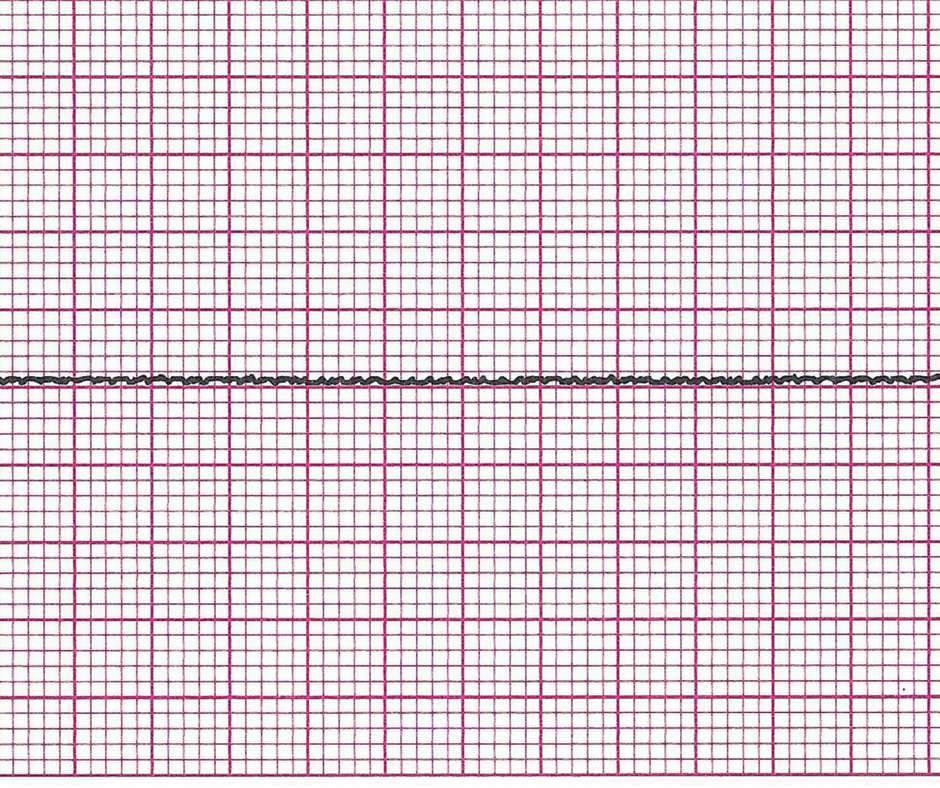 ekg monitor flatline